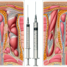 Subcutaneous vs intramuscular administration of methandienone injection